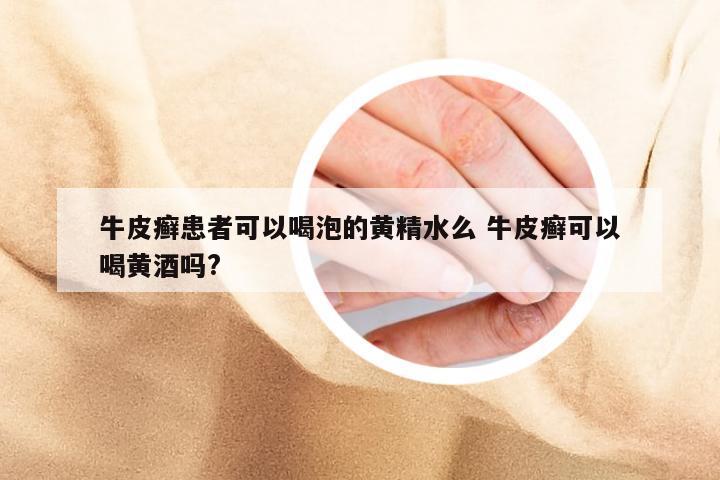 牛皮癣患者可以喝泡的黄精水么 牛皮癣可以喝黄酒吗?