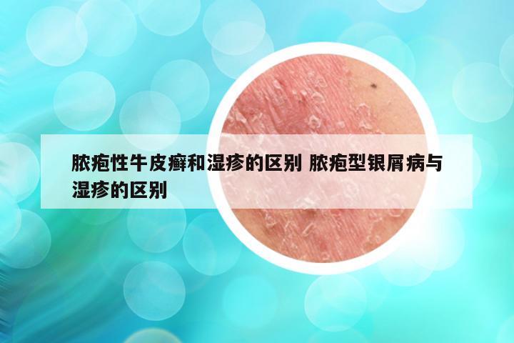 脓疱性牛皮癣和湿疹的区别 脓疱型银屑病与湿疹的区别