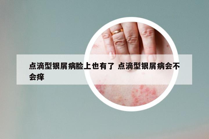 点滴型银屑病脸上也有了 点滴型银屑病会不会痒