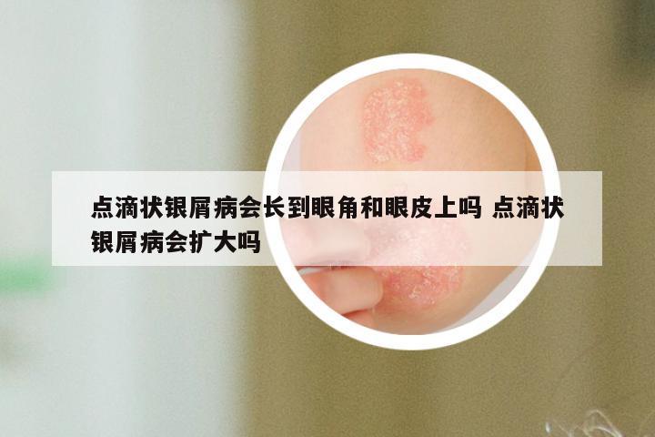点滴状银屑病会长到眼角和眼皮上吗 点滴状银屑病会扩大吗