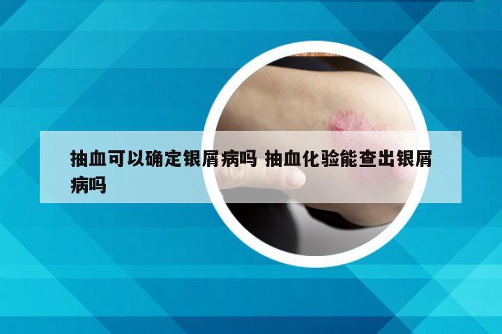 抽血可以确定银屑病吗 抽血化验能查出银屑病吗