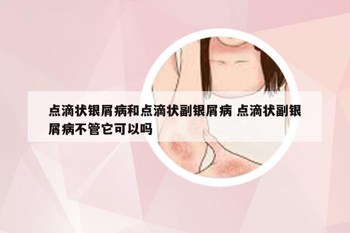 点滴状银屑病和点滴状副银屑病 点滴状副银屑病不管它可以吗