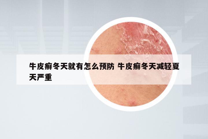 牛皮癣冬天就有怎么预防 牛皮癣冬天减轻夏天严重