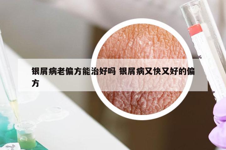 银屑病老偏方能治好吗 银屑病又快又好的偏方