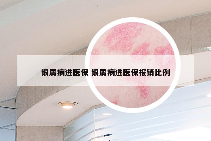 银屑病进医保 银屑病进医保报销比例