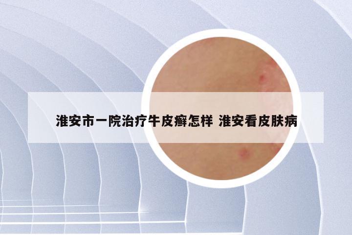 淮安市一院治疗牛皮癣怎样 淮安看皮肤病