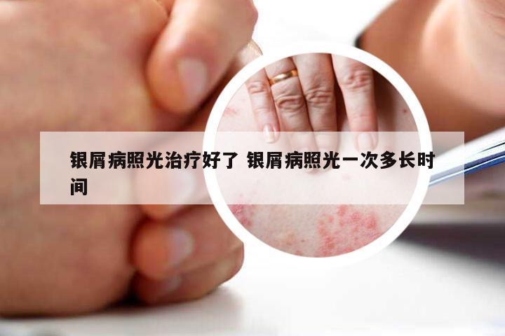 银屑病照光治疗好了 银屑病照光一次多长时间