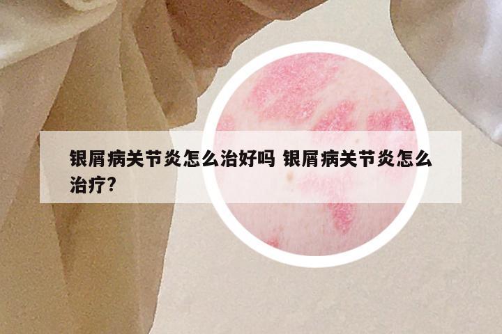 银屑病关节炎怎么治好吗 银屑病关节炎怎么治疗?
