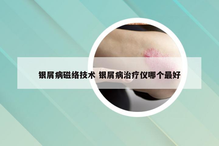 银屑病磁络技术 银屑病治疗仪哪个最好