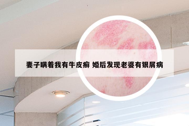 妻子瞒着我有牛皮癣 婚后发现老婆有银屑病