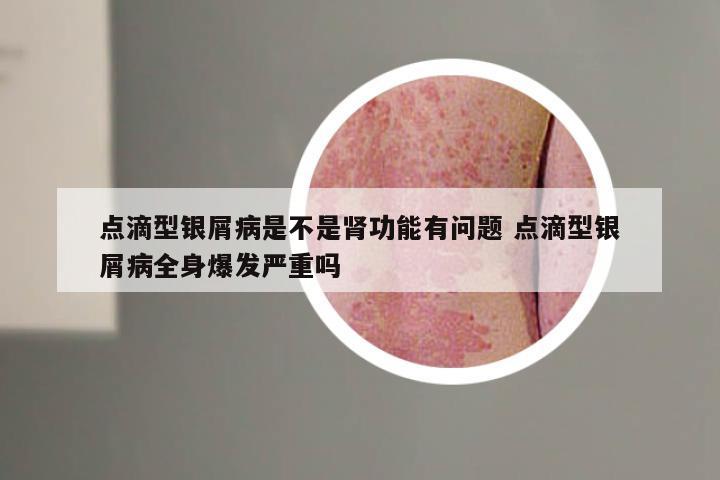 点滴型银屑病是不是肾功能有问题 点滴型银屑病全身爆发严重吗