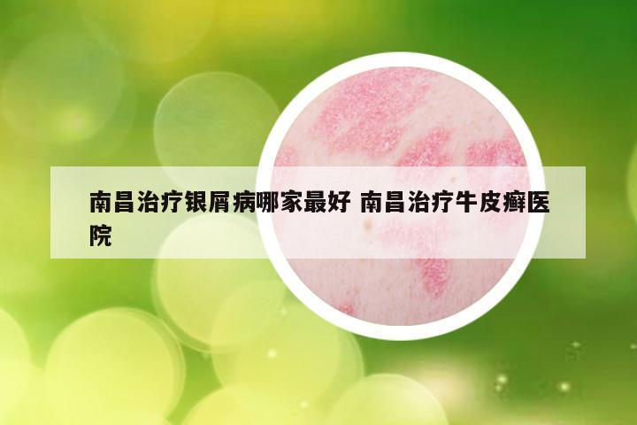 南昌治疗银屑病哪家最好 南昌治疗牛皮癣医院