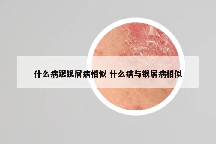 什么病跟银屑病相似 什么病与银屑病相似
