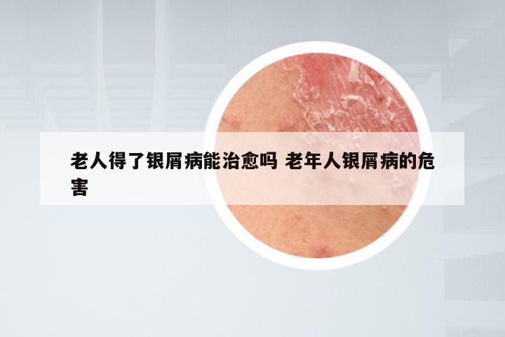 老人得了银屑病能治愈吗 老年人银屑病的危害