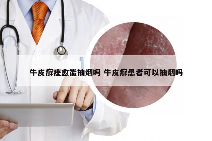 牛皮癣痊愈能抽烟吗 牛皮癣患者可以抽烟吗