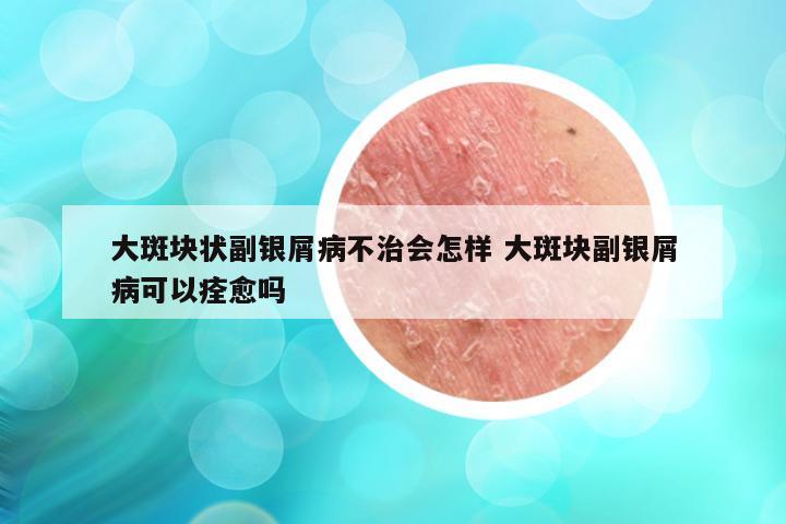 大斑块状副银屑病不治会怎样 大斑块副银屑病可以痊愈吗