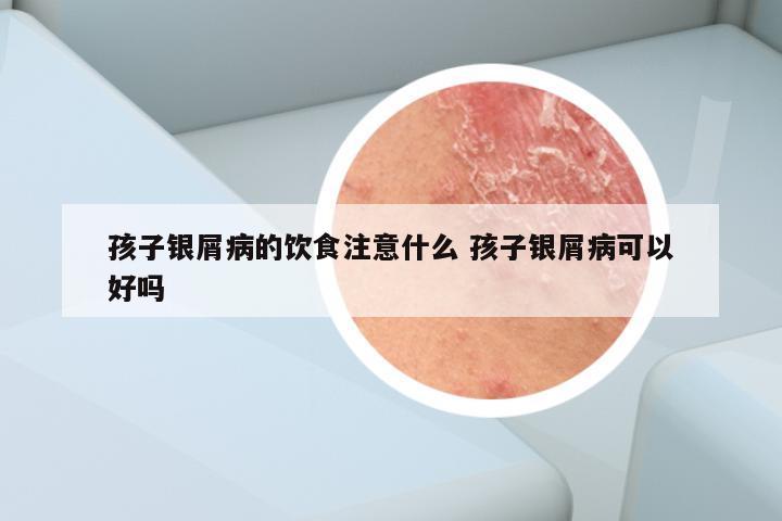 孩子银屑病的饮食注意什么 孩子银屑病可以好吗