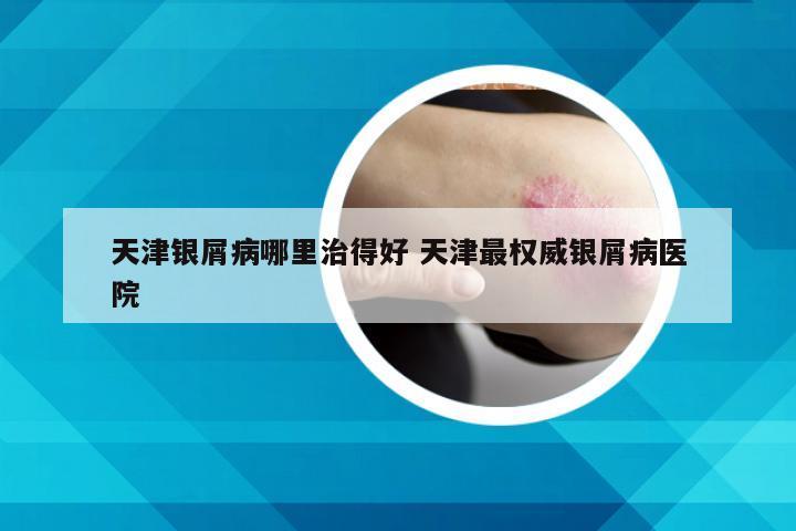 天津银屑病哪里治得好 天津最权威银屑病医院