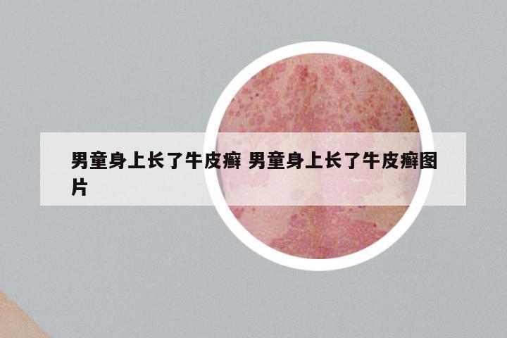 男童身上长了牛皮癣 男童身上长了牛皮癣图片