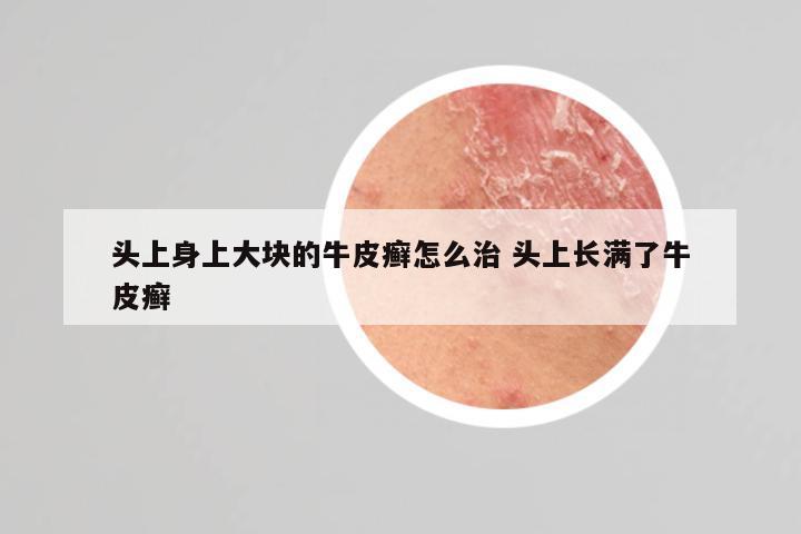 头上身上大块的牛皮癣怎么治 头上长满了牛皮癣