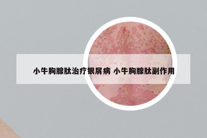 小牛胸腺肽治疗银屑病 小牛胸腺肽副作用