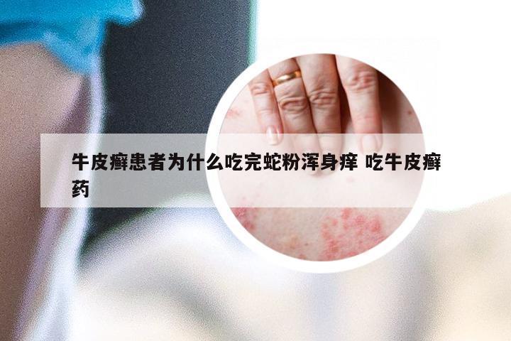 牛皮癣患者为什么吃完蛇粉浑身痒 吃牛皮癣药