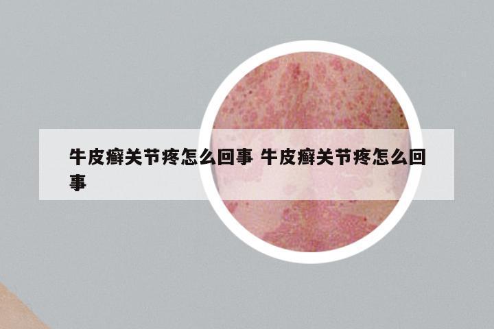 牛皮癣关节疼怎么回事 牛皮癣关节疼怎么回事