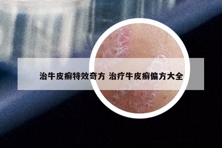 治牛皮癣特效奇方 治疗牛皮癣偏方大全