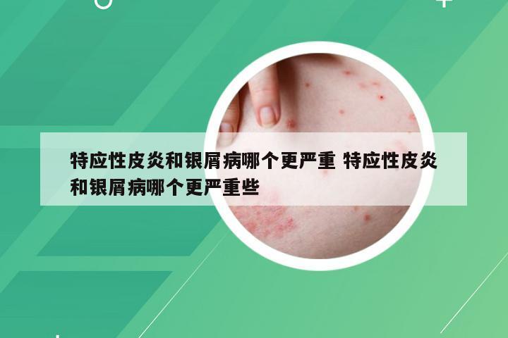 特应性皮炎和银屑病哪个更严重 特应性皮炎和银屑病哪个更严重些