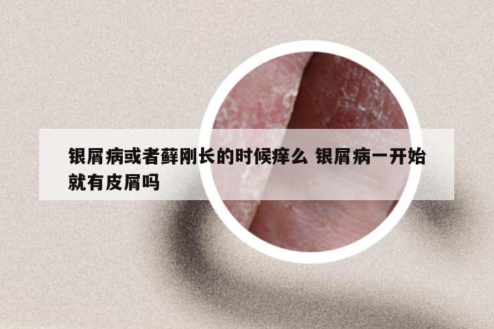 银屑病或者藓刚长的时候痒么 银屑病一开始就有皮屑吗