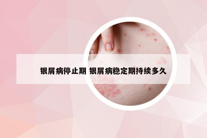 银屑病停止期 银屑病稳定期持续多久
