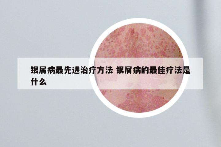 银屑病最先进治疗方法 银屑病的最佳疗法是什么