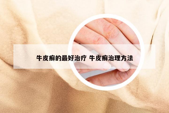 牛皮癣的最好治疗 牛皮癣治理方法