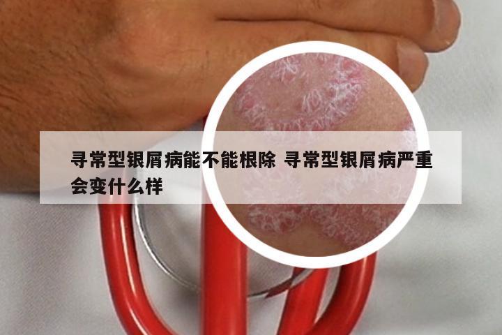 寻常型银屑病能不能根除 寻常型银屑病严重会变什么样