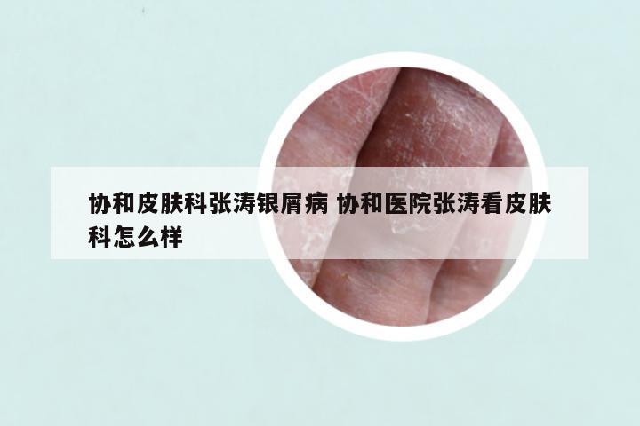 协和皮肤科张涛银屑病 协和医院张涛看皮肤科怎么样