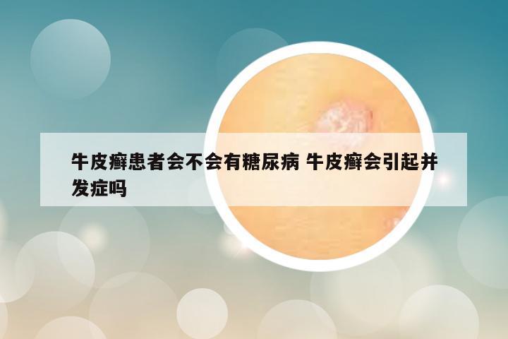 牛皮癣患者会不会有糖尿病 牛皮癣会引起并发症吗