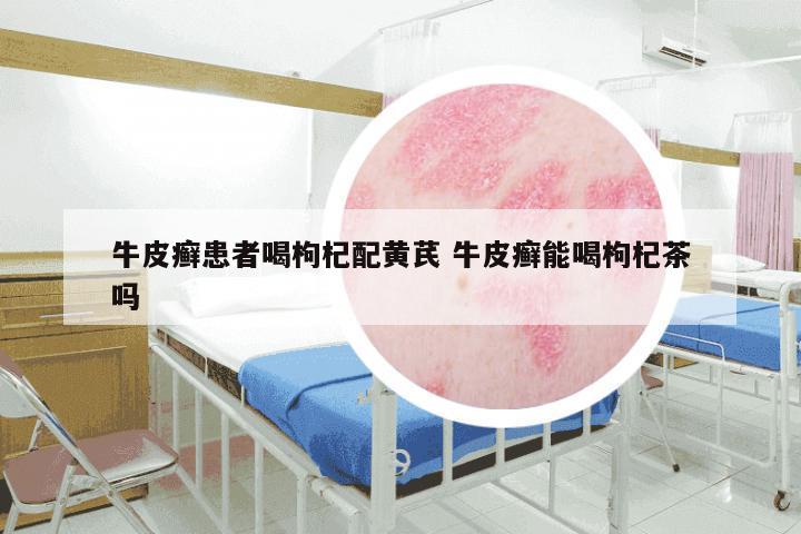 牛皮癣患者喝枸杞配黄芪 牛皮癣能喝枸杞茶吗