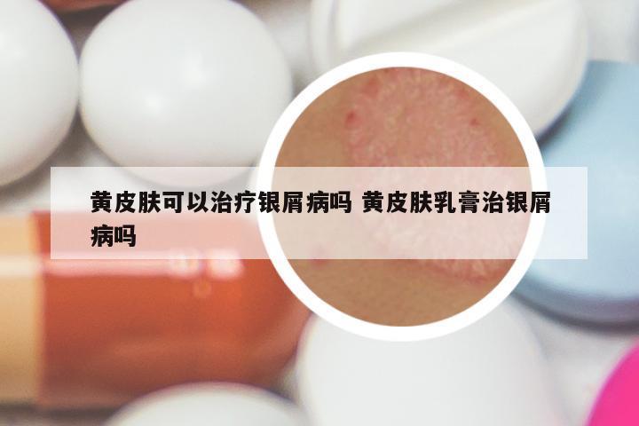 黄皮肤可以治疗银屑病吗 黄皮肤乳膏治银屑病吗