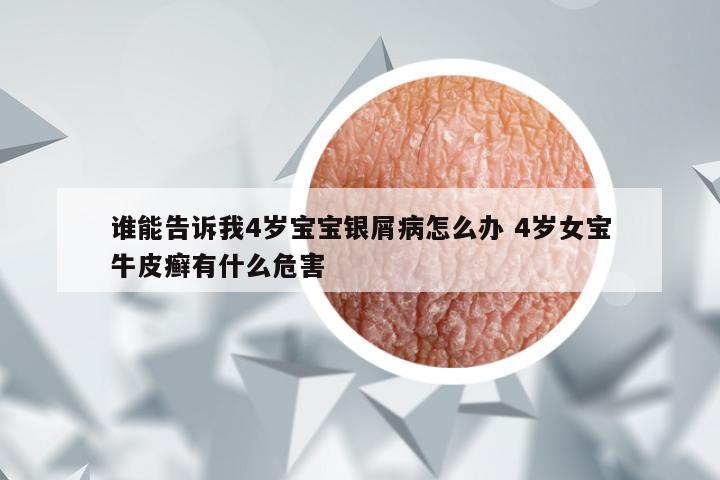 谁能告诉我4岁宝宝银屑病怎么办 4岁女宝牛皮癣有什么危害