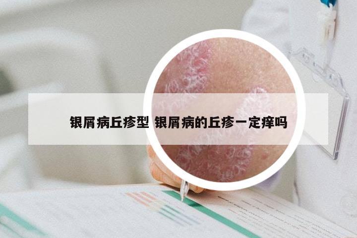 银屑病丘疹型 银屑病的丘疹一定痒吗