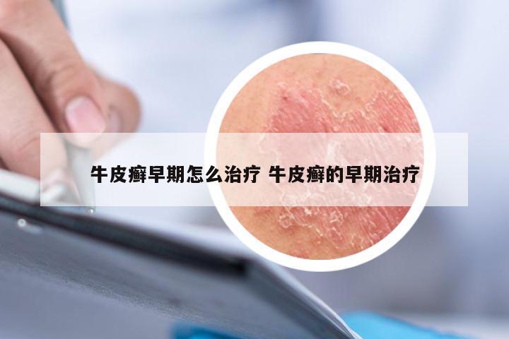 牛皮癣早期怎么治疗 牛皮癣的早期治疗