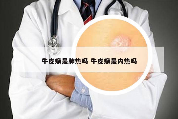 牛皮癣是肺热吗 牛皮癣是内热吗