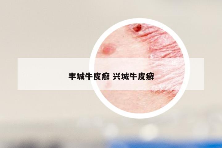 丰城牛皮癣 兴城牛皮癣