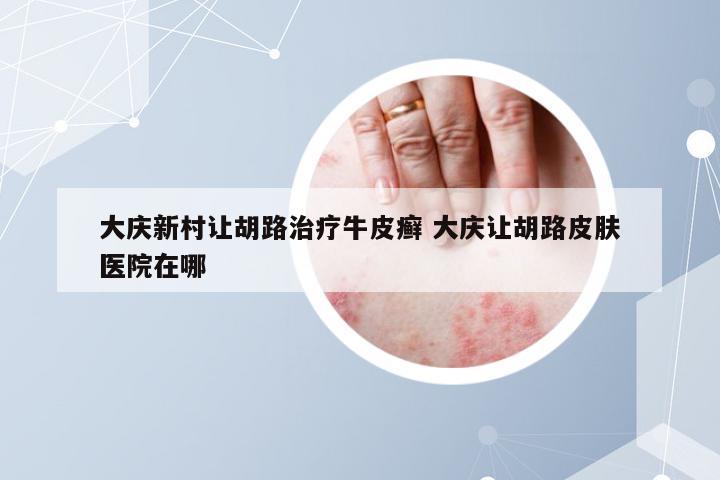 大庆新村让胡路治疗牛皮癣 大庆让胡路皮肤医院在哪