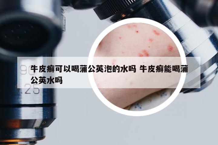 牛皮癣可以喝蒲公英泡的水吗 牛皮癣能喝蒲公英水吗