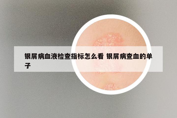 银屑病血液检查指标怎么看 银屑病查血的单子