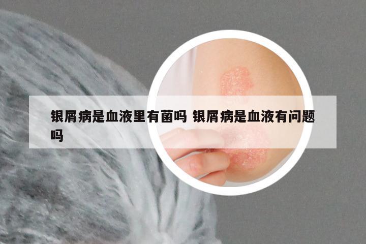 银屑病是血液里有菌吗 银屑病是血液有问题吗