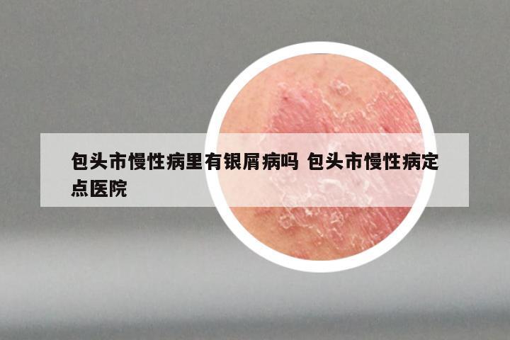 包头市慢性病里有银屑病吗 包头市慢性病定点医院