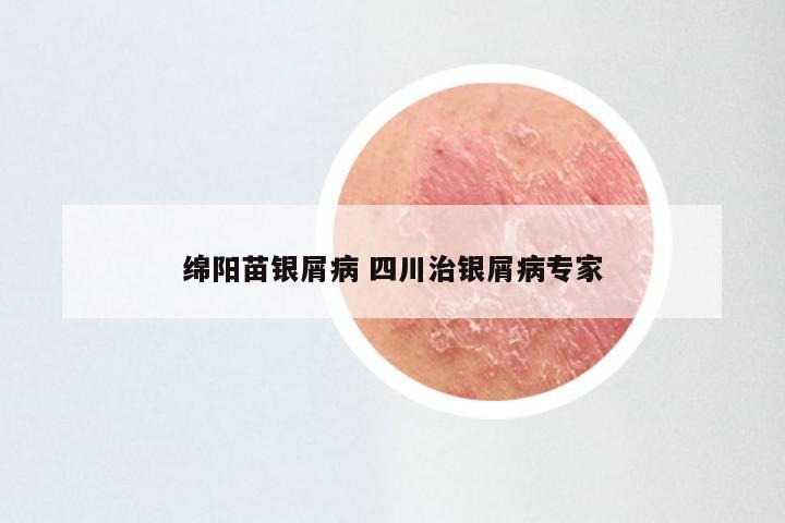 绵阳苗银屑病 四川治银屑病专家