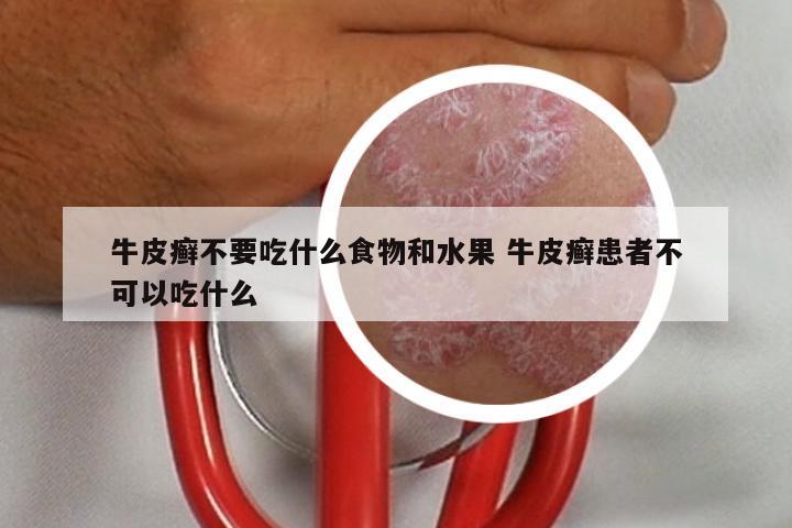 牛皮癣不要吃什么食物和水果 牛皮癣患者不可以吃什么